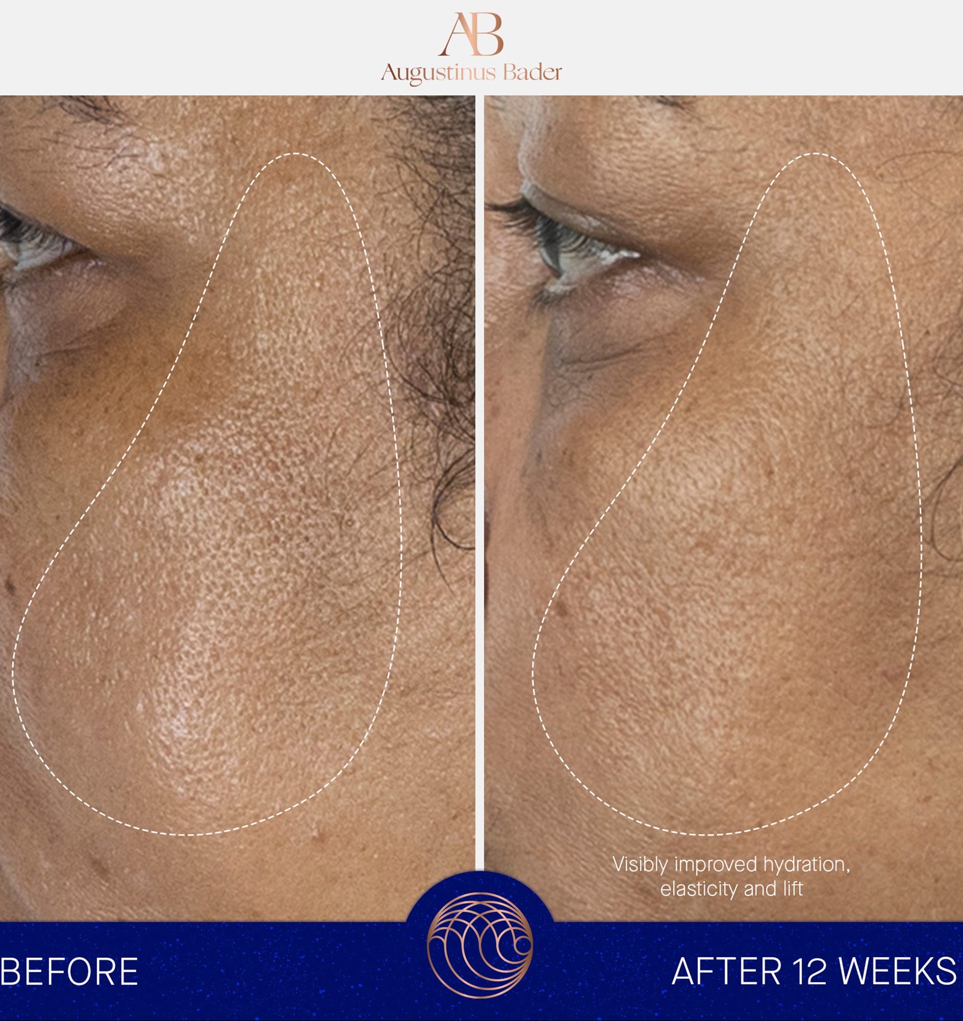 Augustinus Bader before and after 12 weeks – improved skin hydration and elasticity